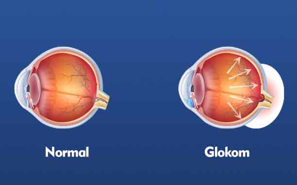 Glokom (Göz Tansiyonu): Sessiz İlerleyen Görme Kaybı Riski
