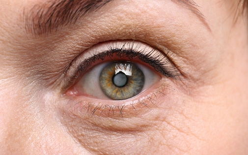 Katarakt: Belirtiler, Nedenler ve Modern Tedavi Yöntemleri